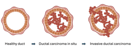 Invasive ductal carcinoma
